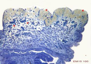 F,8m. | lipid malabsorption - large lipid droplets in enterocytes … semithin section F,8m. | lipid malabsorption - large lipid droplets in enterocytes … semithin section